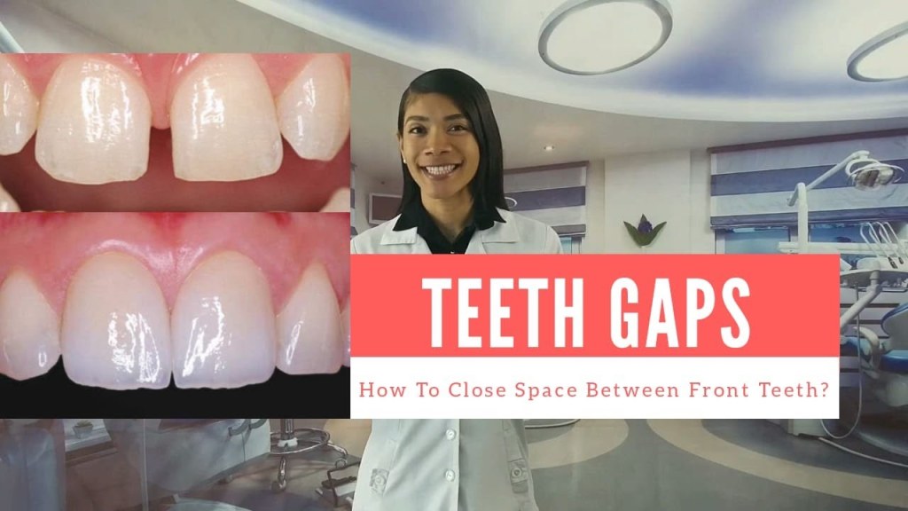 Picture of: #GAPS BETWEEN TEETH? – FAST AND CHEAP WAYS TO CLOSE GAPS WITHOUT BRACES –  Cosmetic Dentistry